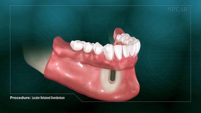 Implant Retained Dentures Lengby MN 56651